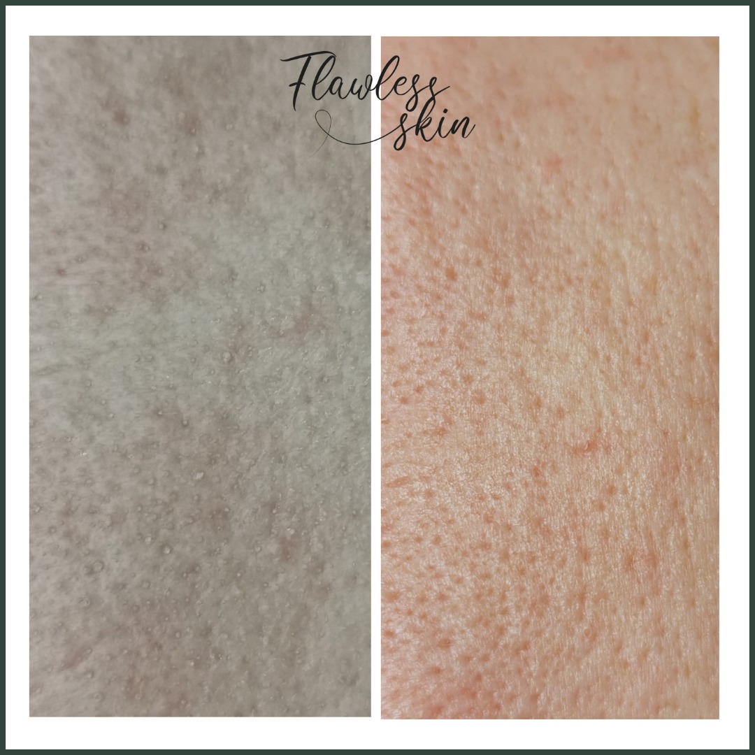 Porównanie skóry twarzy przed i po zabiegu, widoczne zmniejszenie porów i poprawa tekstury; napis 'Flawless skin' w prawym górnym rogu.