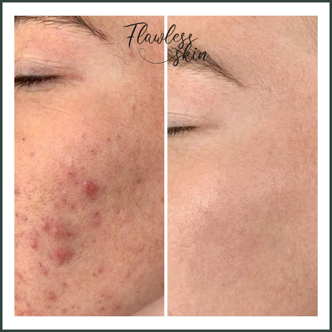 Porównanie skóry twarzy przed i po zabiegu: po lewej stronie widoczne zmiany trądzikowe, po prawej skóra gładka, z bliska, z zamkniętymi oczami.