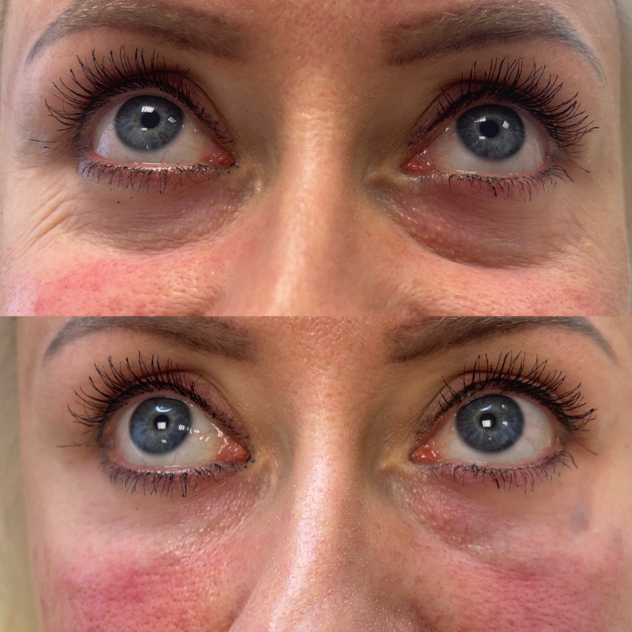 Zbliżenie na oczy kobiety przed i po zabiegu redukcji zmarszczek pod oczami. Widoczne zaczerwienienia skóry po zabiegu.