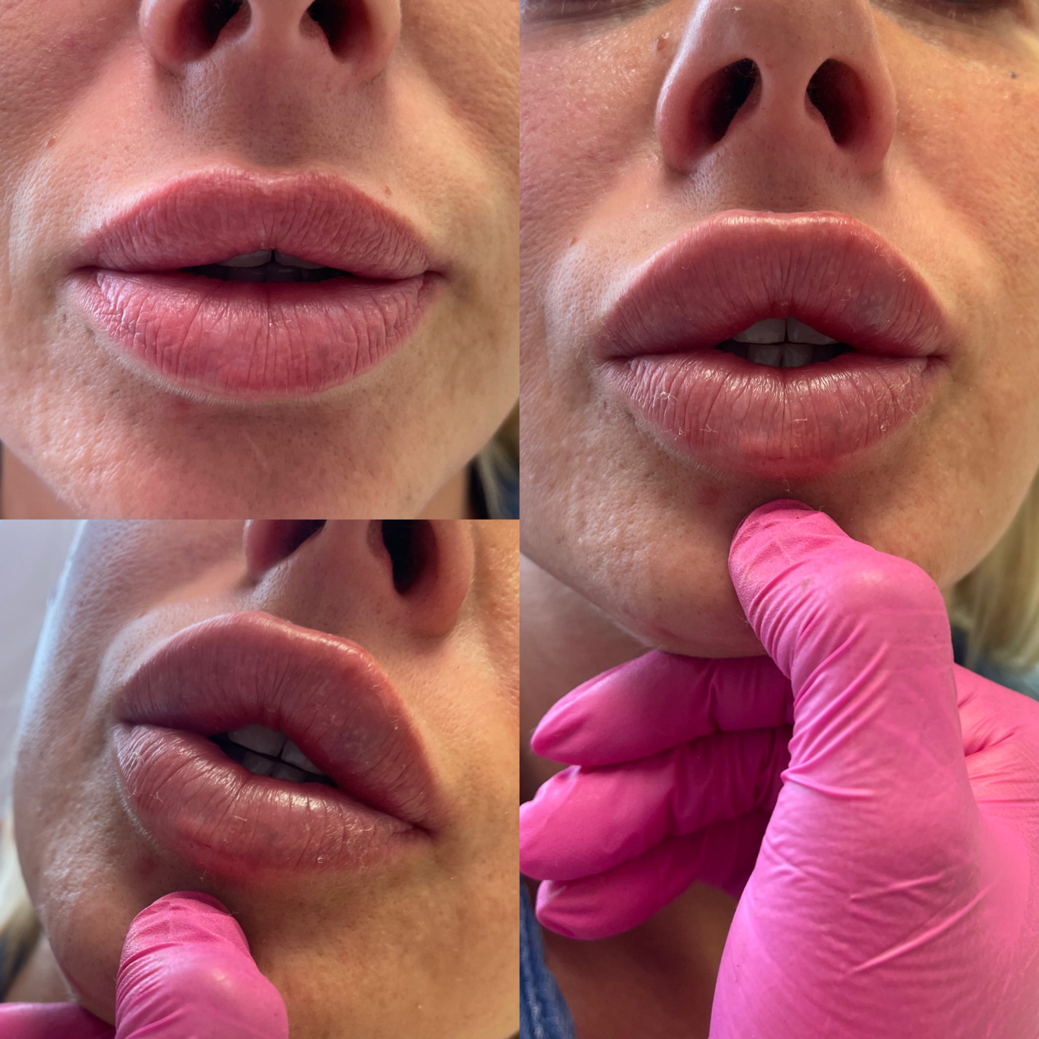 Zbliżenie na usta kobiety przed i po zabiegu powiększania, widoczne w trzech różnych ujęciach, jedno z nich z ręką w różowej rękawiczce dotykającą podbródka.