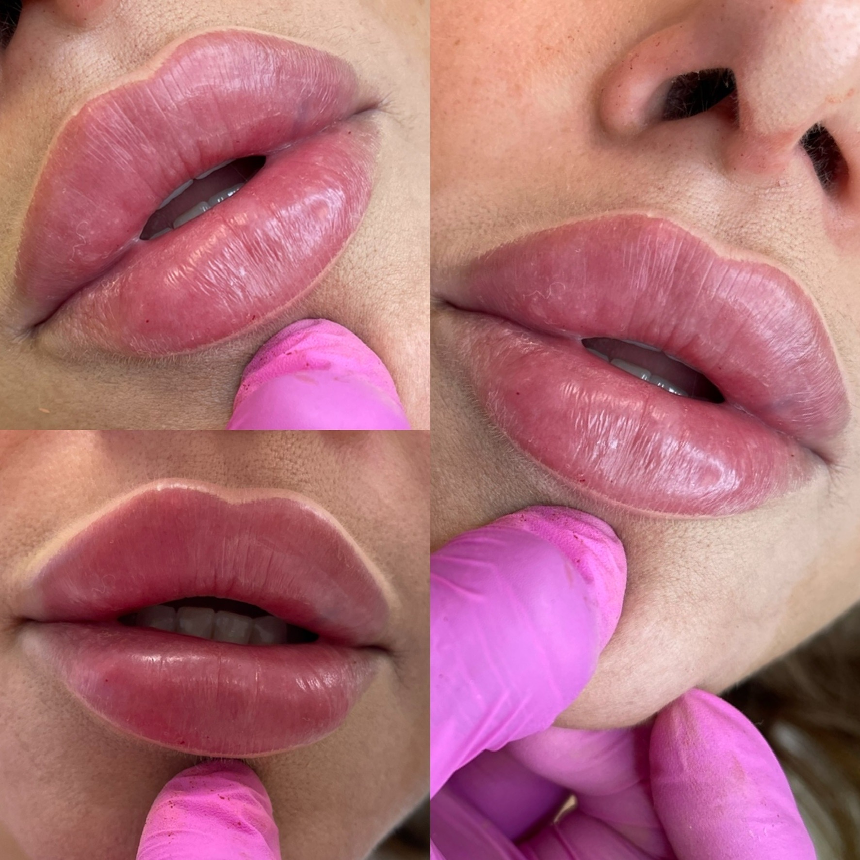 Zbliżenie na usta kobiety po zabiegu makijażu permanentnego, widoczne świeże pigmentacje i opuchlizna, w trakcie korekty przez osobę w różowych rękawiczkach.