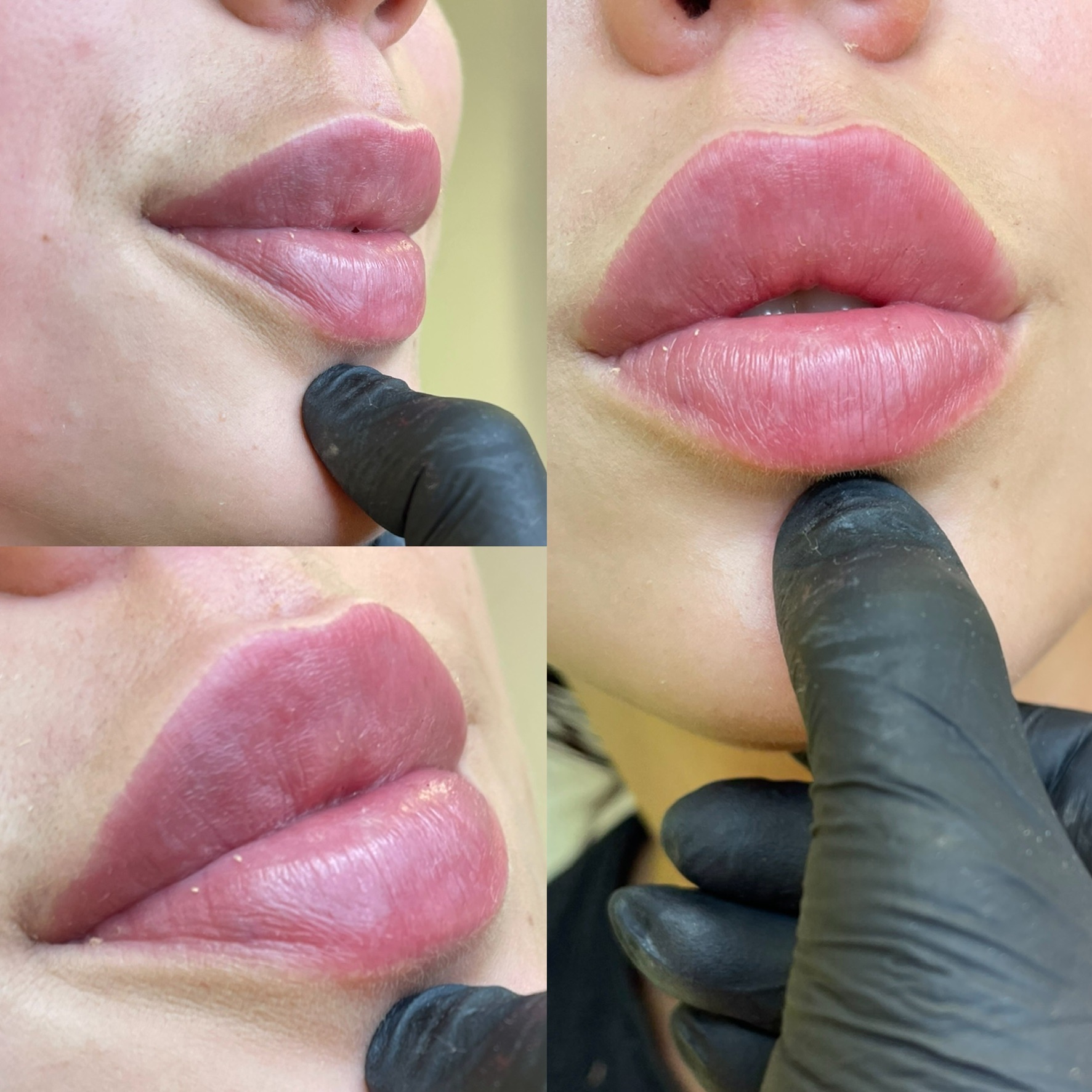 Zbliżenie na usta kobiety po zabiegu powiększania, widoczne delikatne zaczerwienienie i opuchlizna, dotykane palcem w czarnej rękawiczce.