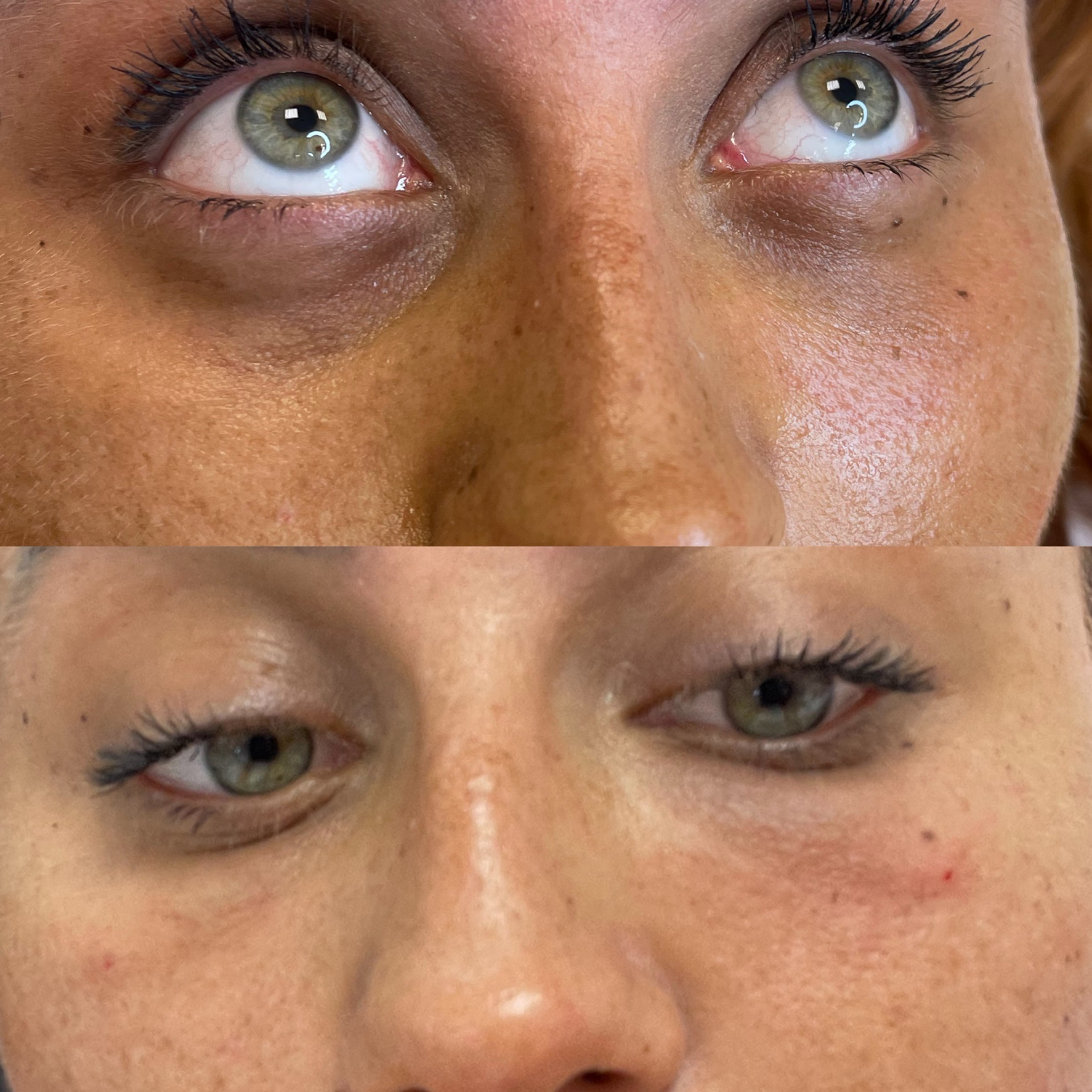 Zbliżenie na twarz kobiety przed i po zabiegu redukcji cieni pod oczami, widoczne jaśniejsze i bardziej napięte okolice oczu po zabiegu.