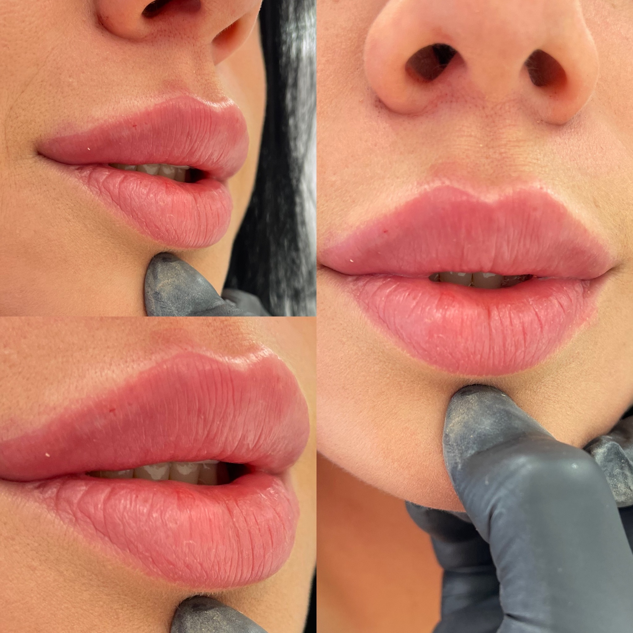 Zbliżenie na usta kobiety po zabiegu powiększania, widoczne subtelne zmiany w kształcie i objętości, skóra delikatnie napięta, na dole kadru dłoń w czarnej rękawiczce.