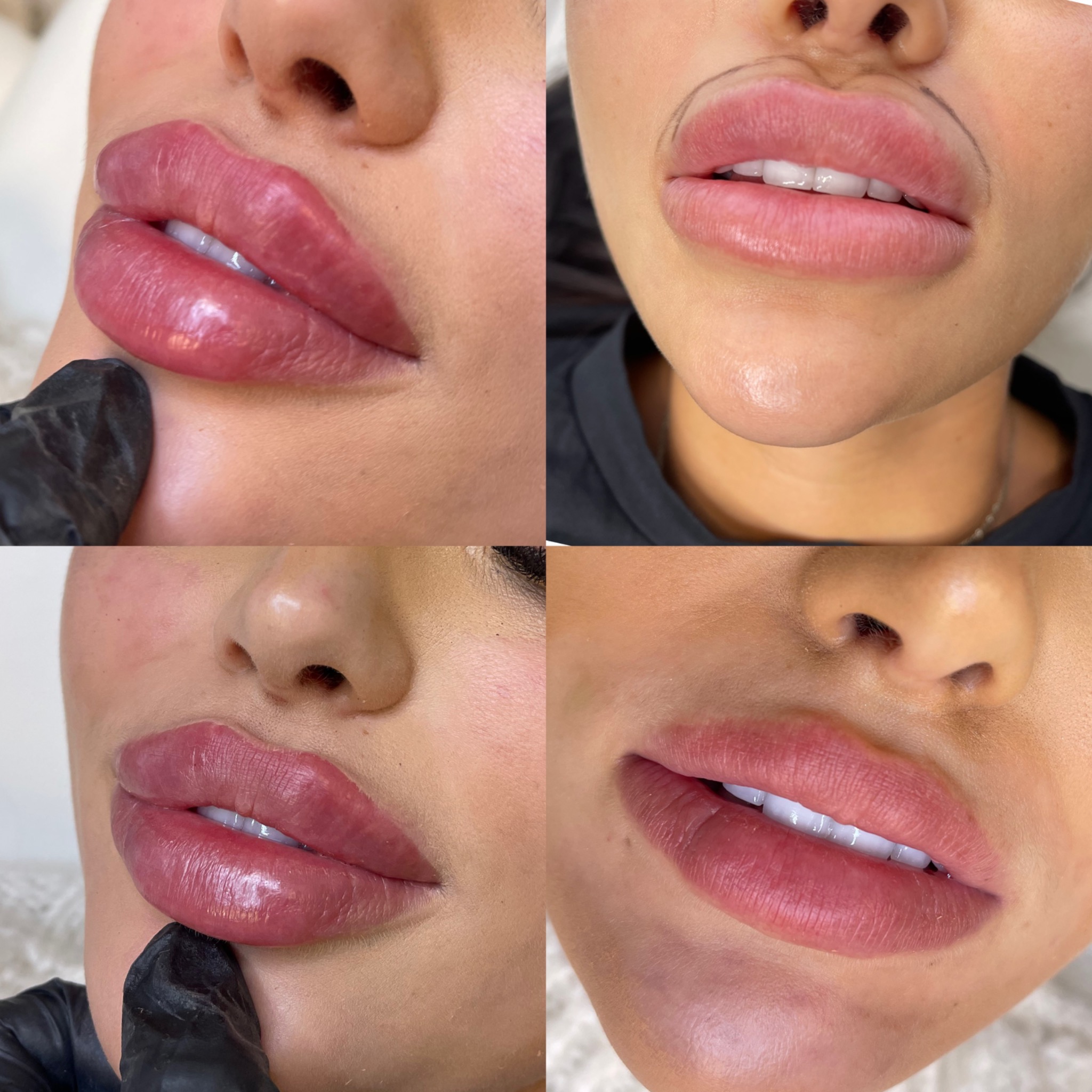 Zbliżenie na usta kobiety przed i po zabiegu powiększania, widoczne wypełniacze i kontur przed zabiegiem.