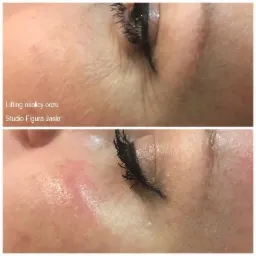 HIFU lifting okolica oka