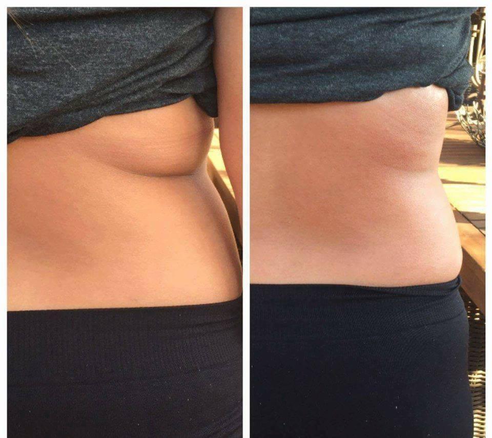 Zdjęcie porównujące sylwetkę brzucha przed i po zabiegu, widoczne różnice w jędrności skóry i redukcji tkanki tłuszczowej, ujęcie z boku w naturalnym oświetleniu.