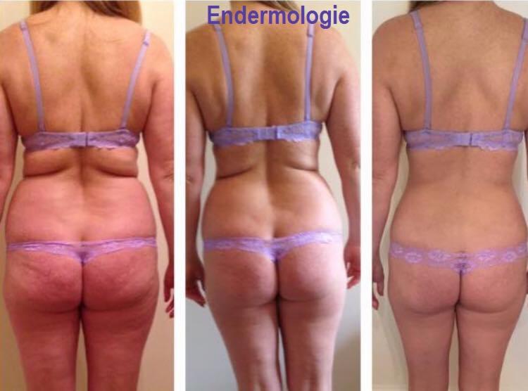 Efekty Endermologia