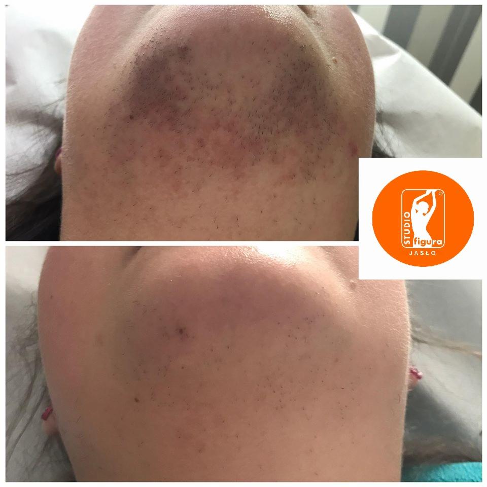 Depilacja Laserowa -efekt