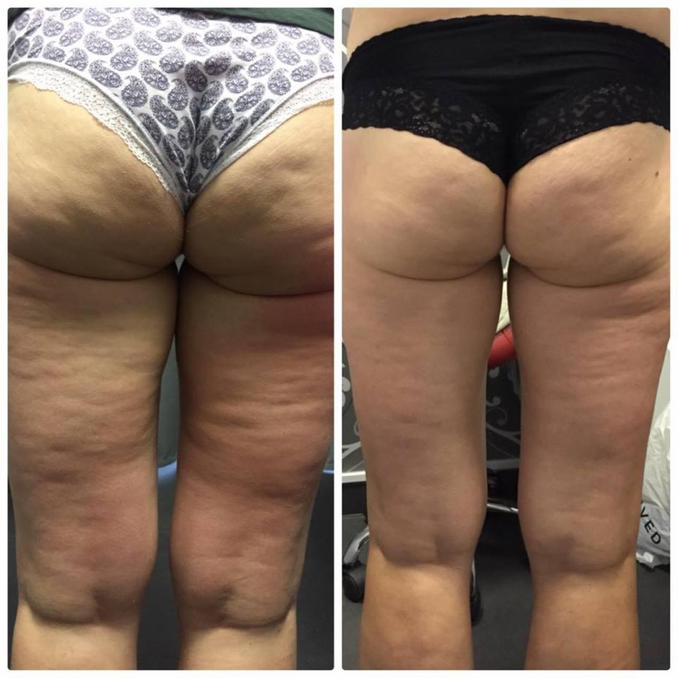 Zdjęcie przedstawia porównanie nóg i pośladków przed i po zabiegu. Po lewej stronie widoczne są nogi w majtkach z wzorem, a po prawej te same nogi w czarnych koronkowych majtkach, ukazujące...