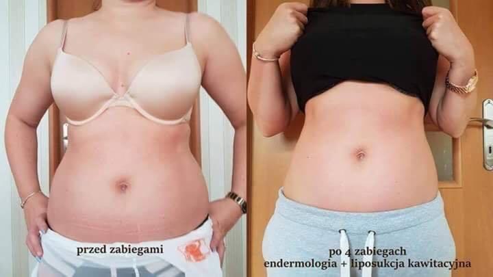 Porównanie sylwetki kobiety przed i po serii zabiegów endermologii i liposukcji kawitacyjnej, widoczne zmniejszenie obwodu talii i poprawa napięcia skóry.