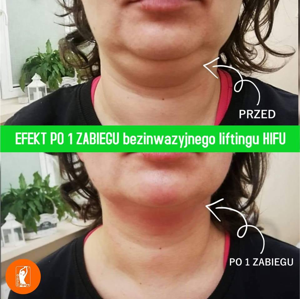 Lifting podbródka HiFu