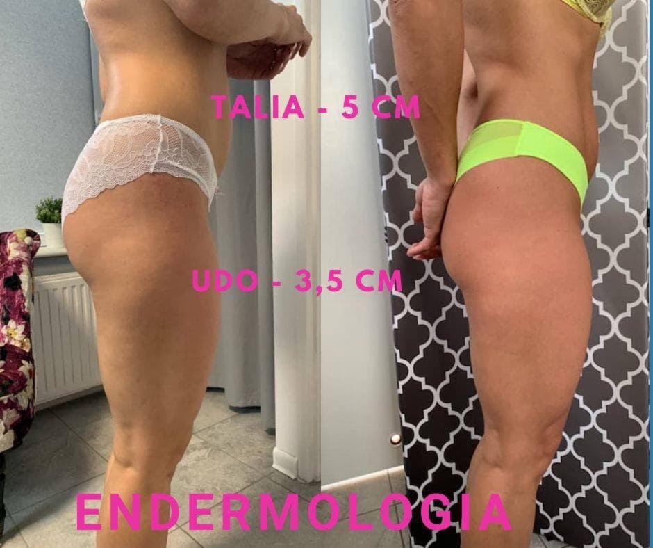 Endermologia efekty