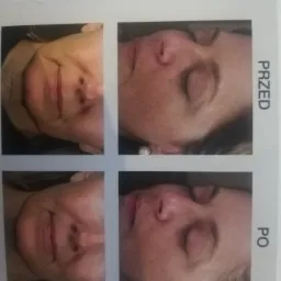 Kolaż przedstawiający twarz kobiety przed i po zabiegu medycyny estetycznej, ukazujący redukcję zmarszczek i poprawę napięcia skóry.