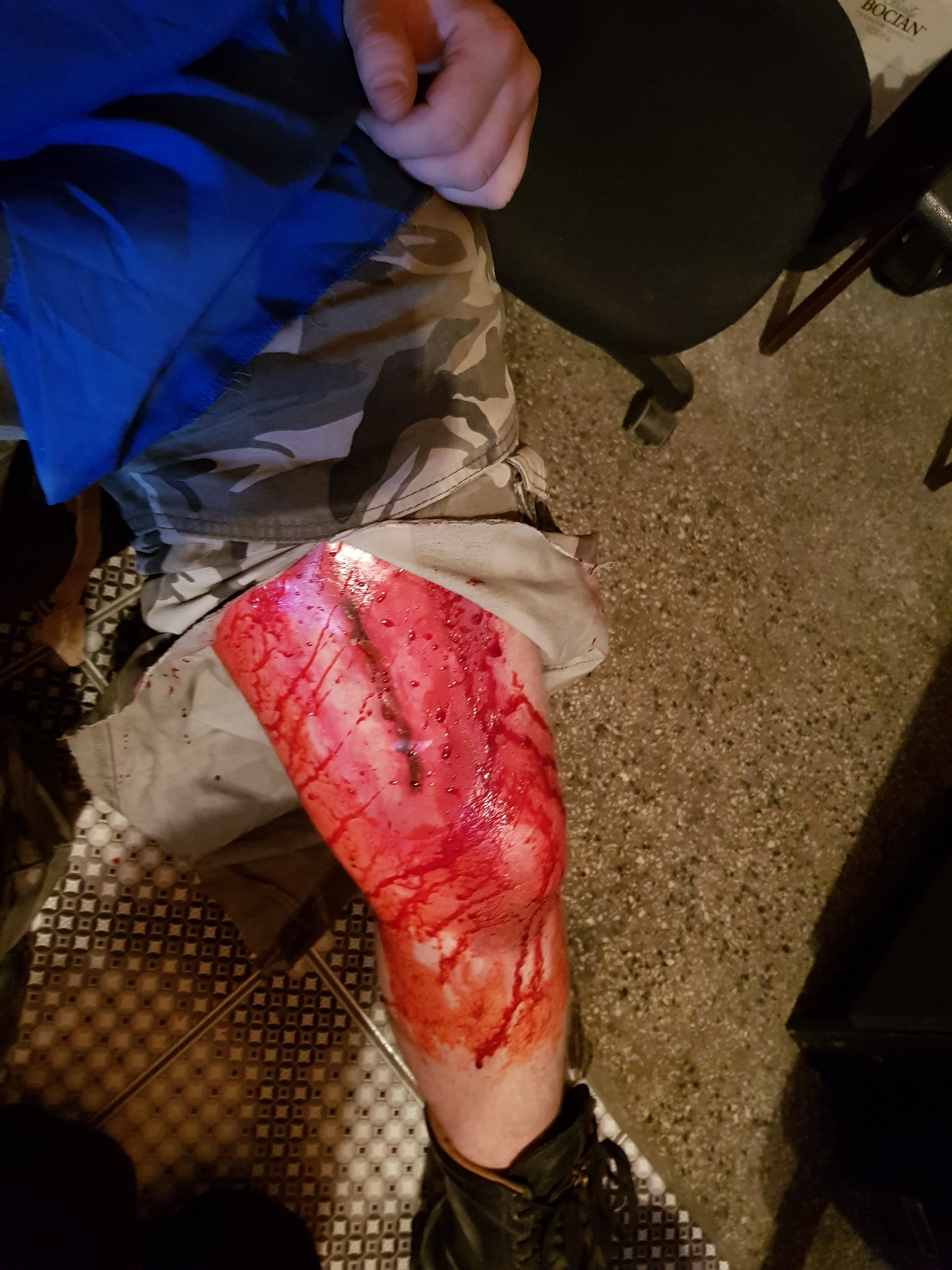 Otwarta rana na kolanie, widoczne rozcięcie skóry i krew, osoba w spodniach moro siedzi na krześle.