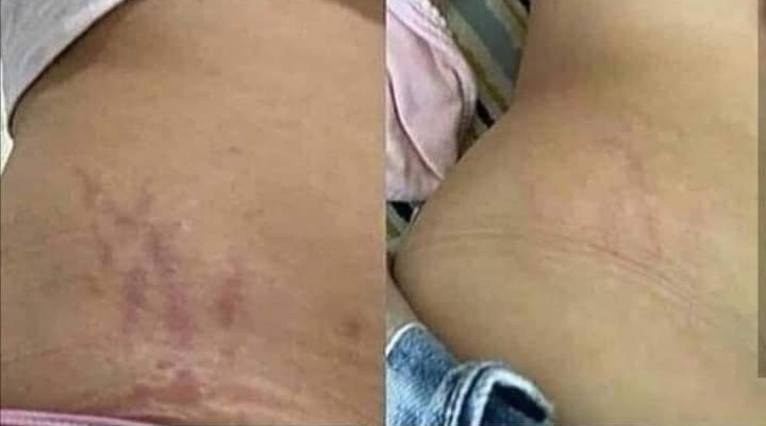 Porównanie skóry brzucha i uda przed i po zabiegu redukcji rozstępów, widoczne zmniejszenie widoczności blizn.