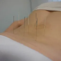 Pacjent leżący na brzuchu z igłami do akupunktury w dolnej części pleców, widoczne białe prześcieradło i szare tło.