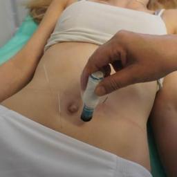 Acumedis Akupunktura - Pacjentka leżąca na zielonym podkładzie, z igłami wkłutymi w brzuch, na którym terapeuta przykłada rozgrzewający cylinder z czarnym dymem.