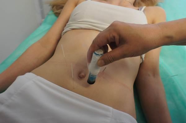 Pacjentka leżąca na zielonym podkładzie, z igłami wkłutymi w brzuch, na którym terapeuta przykłada rozgrzewający cylinder z czarnym dymem.