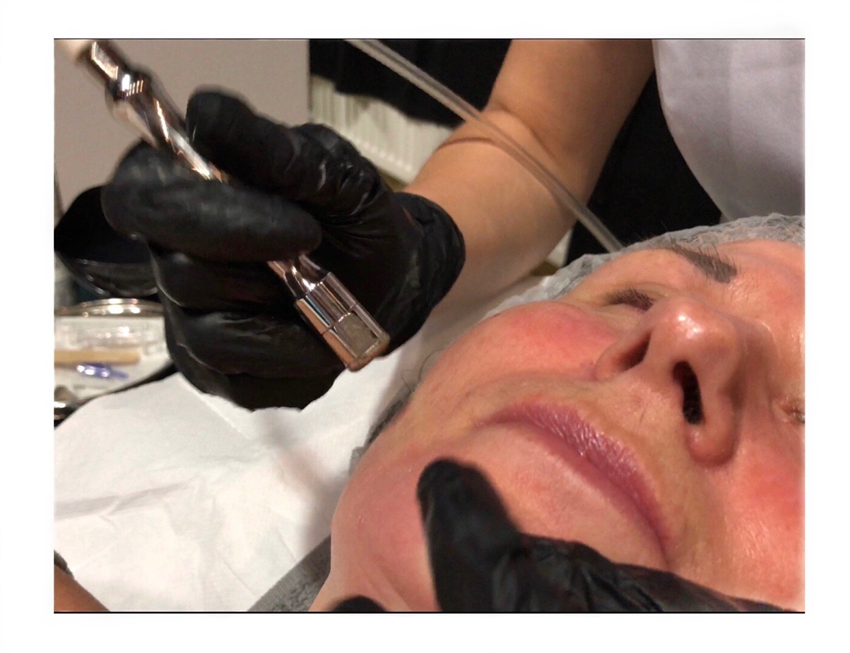 Mikrodermabrazja - 80