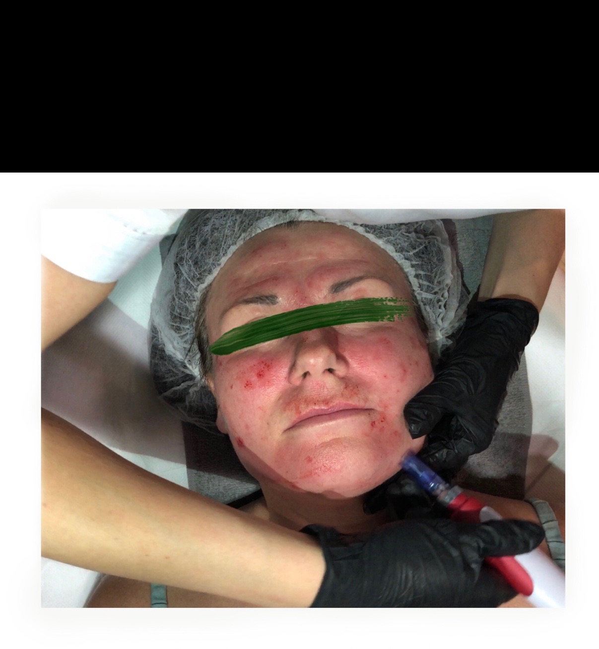 Mezoterapia mikroigłowa (mezo koktajl) - 200