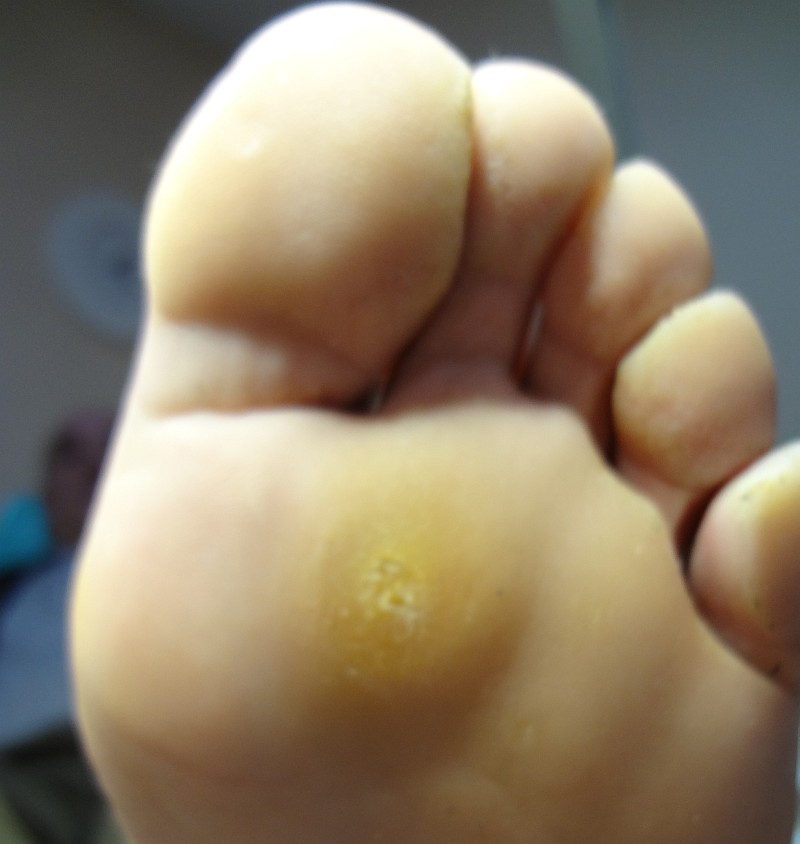 Usuwanie Odcisków na Stopach