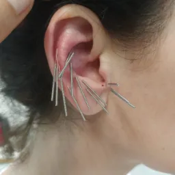 Igły w uchu pacjentki podczas zabiegu, widok z bliska na spiralne igły w różnych punktach małżowiny usznej, delikatne zaczerwienienie skóry.