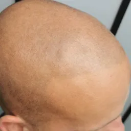 Gładko ogolona głowa mężczyzny z bliska, widoczny delikatny meszek i nierównomierny koloryt skóry.