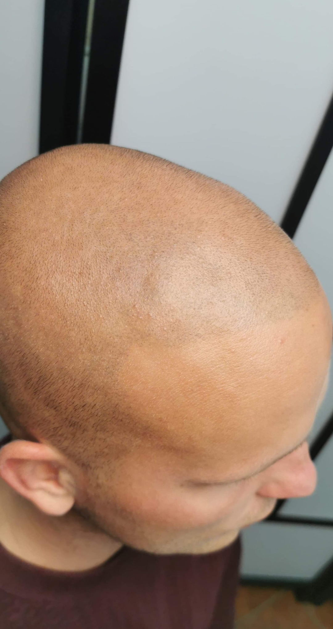 Gładko ogolona głowa mężczyzny z bliska, widoczny delikatny meszek i nierównomierny koloryt skóry.