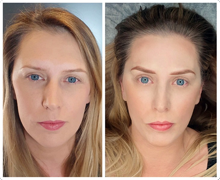 Zdjęcie przedstawia twarz kobiety przed i po wykonaniu stylizacji brwi. Po lewej stronie widać naturalne brwi, a po prawej brwi po zabiegu z wyraźnie zdefiniowanym kształtem i kolorem.