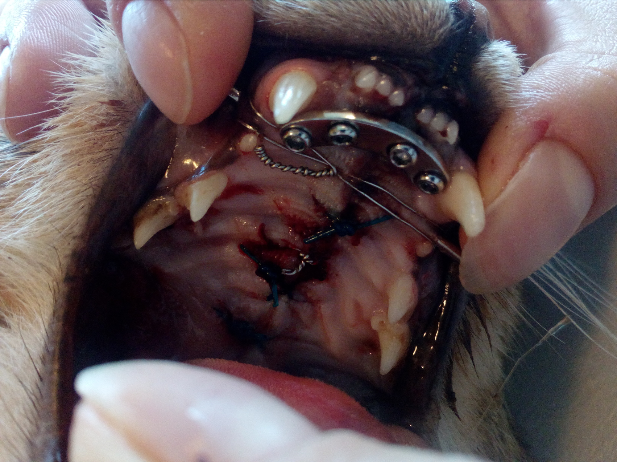 Osteosynteza - Rekonstrukcja Szczęki po Rozległym Urazie Komunikacyjnym