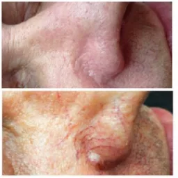 Zbliżenie na skórę twarzy przed i po zabiegu usunięcia zmiany skórnej przy nosie, widoczne zaczerwienienia i naczynka.