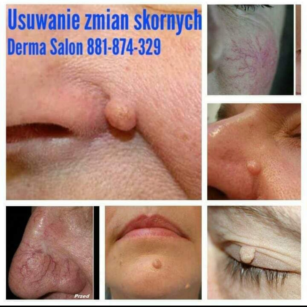 Kompozycja zdjęć przedstawiających zmiany skórne (brodawki, naczyniaki) na twarzy przed potencjalnym usunięciem, z widocznym tekstem 'Usuwanie zmian skórnych Derma Salon 881-874-329'.