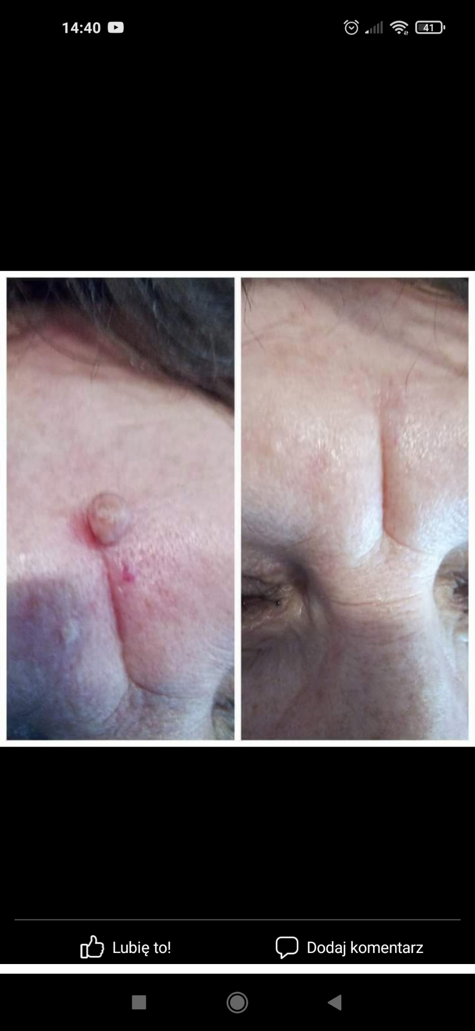 Porównanie skóry przed i po zabiegu usunięcia zmiany skórnej na czole, widoczne zaczerwienienie i opuchlizna w miejscu usunięcia.