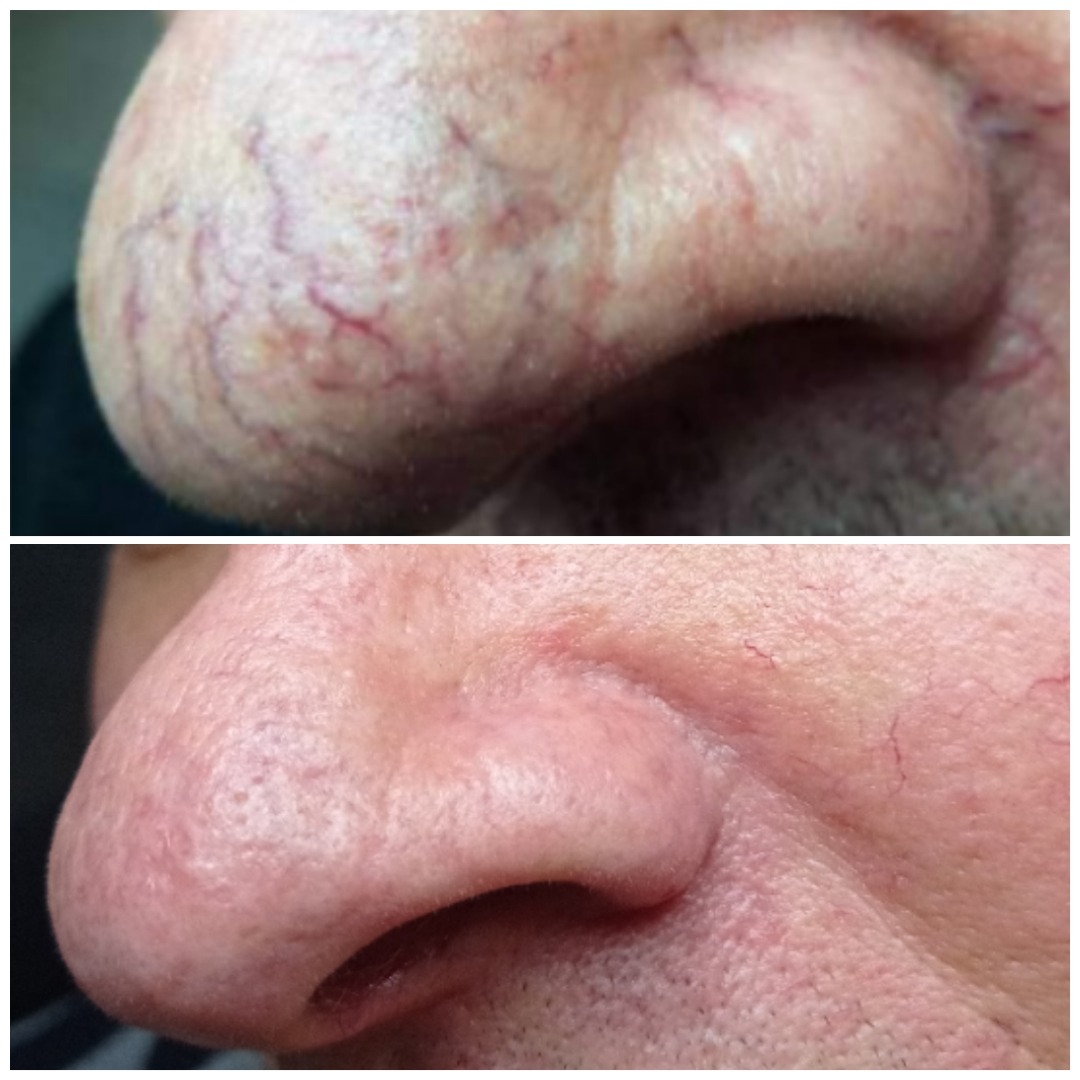 Zbliżenie nosa mężczyzny przed i po zabiegu redukcji popękanych naczynek, widoczne wyraźne zmniejszenie zaczerwienienia i żyłek.