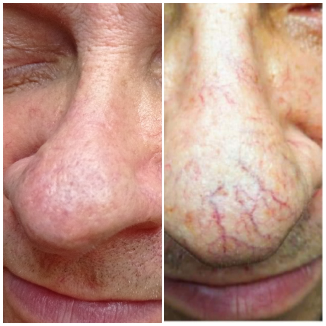 Zbliżenie nosa mężczyzny przed i po zabiegu usuwania naczynek, widoczne czerwone pajączki na skórze.