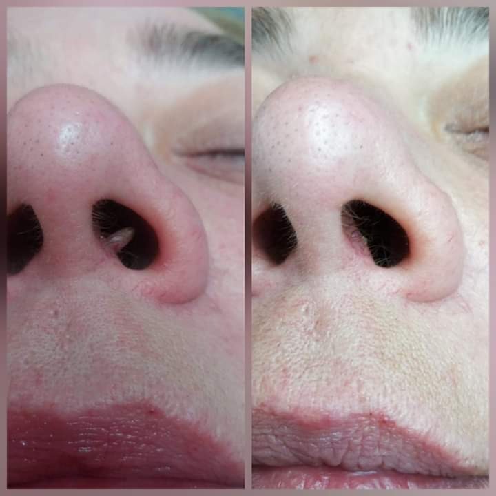 Zbliżenie na nos i usta przed i po zabiegu oczyszczania porów w Chojnicach, widoczne zaczerwienienia i zmiany skórne.
