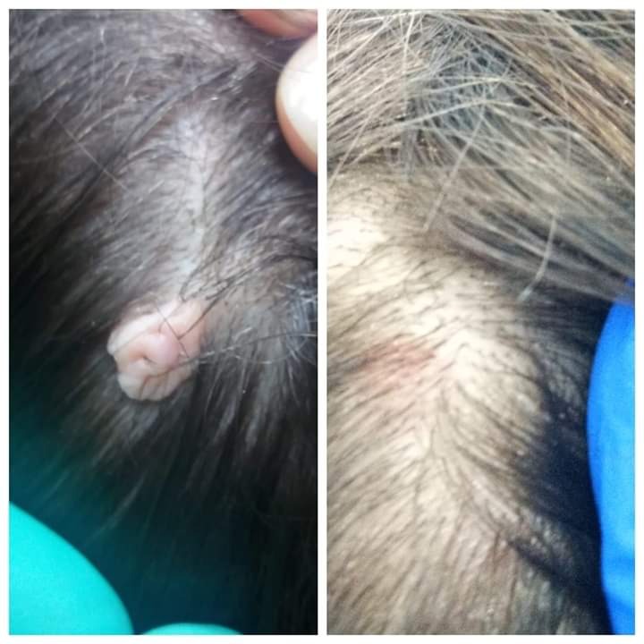 Zbliżenie na skórę głowy przed i po zabiegu usunięcia zmiany skórnej, widoczne zaczerwienienie po zabiegu.