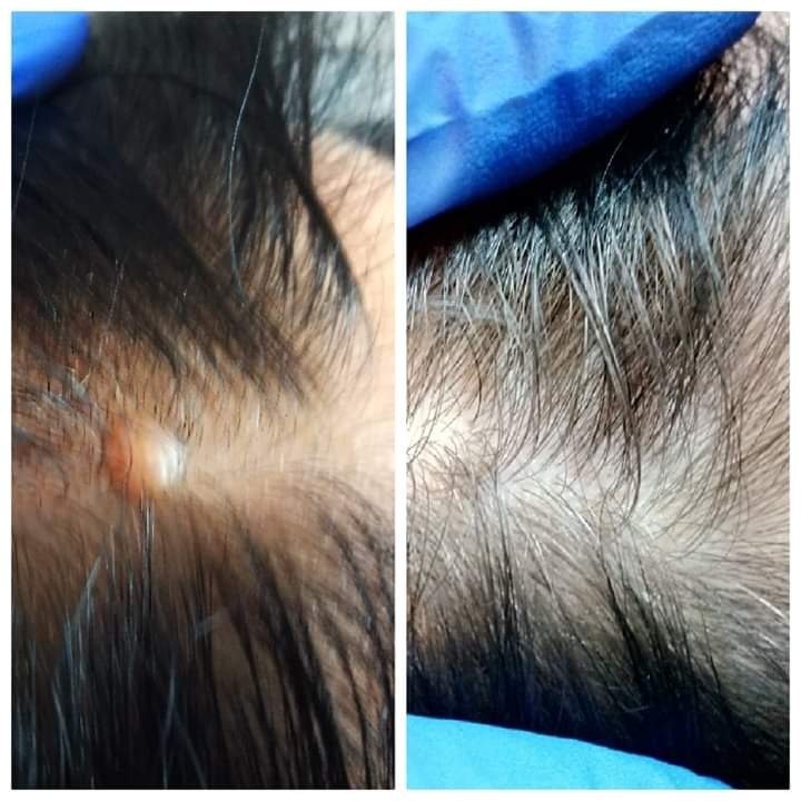 Zbliżenie skóry głowy przed i po usunięciu zmiany skórnej, widoczne rękawice ochronne.