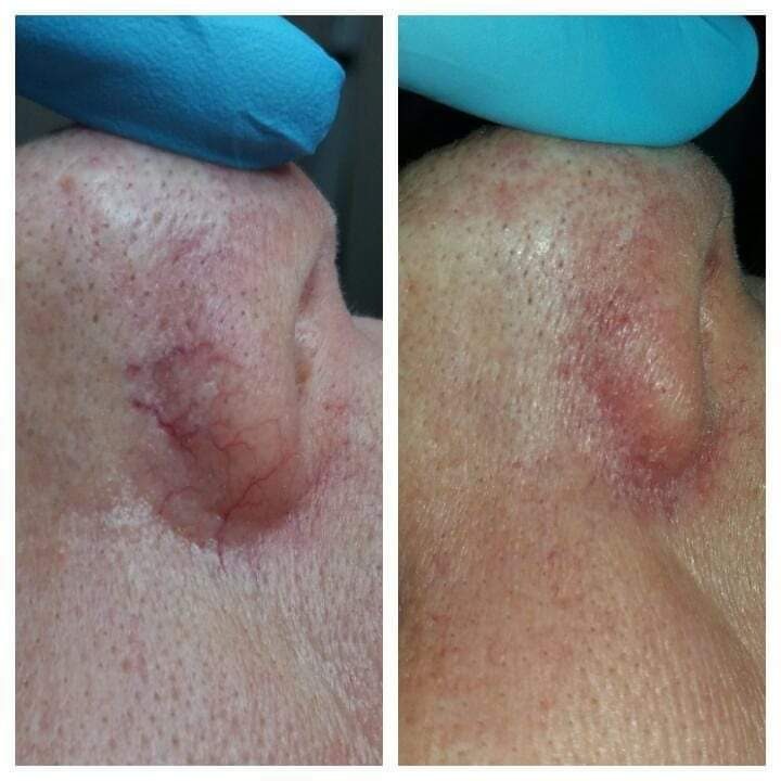 Zbliżenie na nos z widocznymi naczynkami i zaczerwienieniem skóry, przed i po zabiegu, z niebieską rękawiczką w tle.