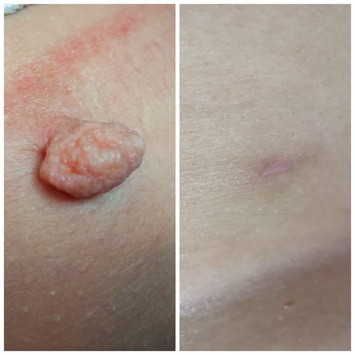 Zdjęcie porównawcze skóry przed i po usunięciu zmiany skórnej, widoczny efekt zabiegu.
