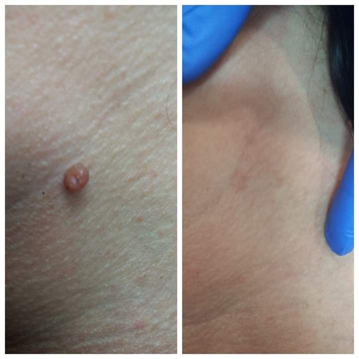 Zdjęcie porównawcze: skóra przed i po zabiegu usunięcia brodawki, widoczna zmiana w strukturze skóry, na szyi ślad po zabiegu, dłoń w niebieskiej rękawiczce.