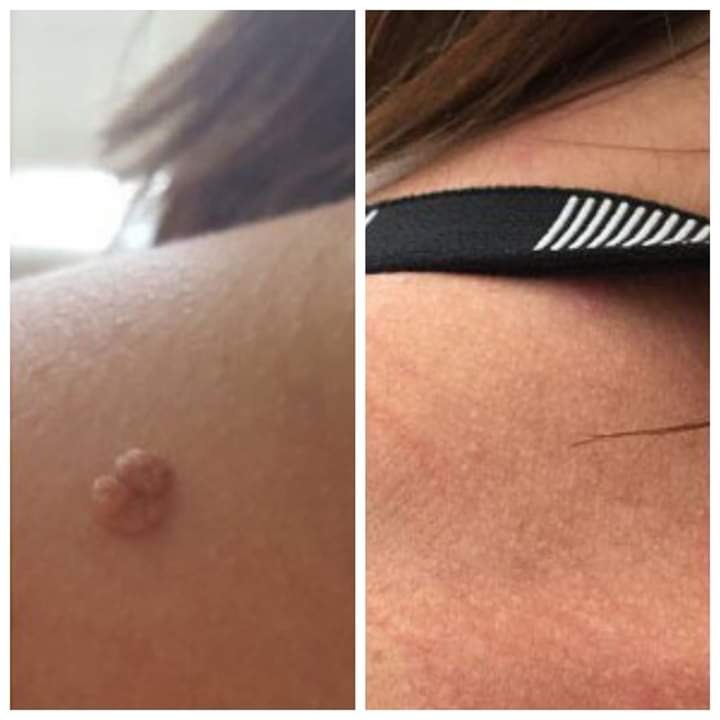 Porównanie skóry przed i po zabiegu usunięcia brodawki na ramieniu, widoczne zaczerwienienie po zabiegu.