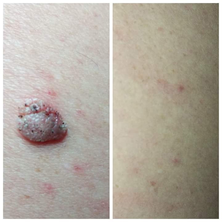 Porównanie skóry przed i po zabiegu usunięcia zmiany skórnej, widoczna różnica w teksturze i kolorycie skóry.