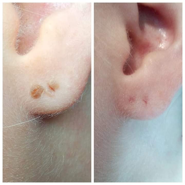 Ucho przed i po zabiegu usunięcia zmian skórnych; po lewej stronie widoczne brązowe narośle, po prawej niewielkie zaczerwienienia w miejscu interwencji.