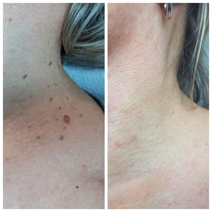 Porównanie skóry szyi i ramienia przed i po zabiegu usuwania zmian skórnych, widoczne znaczące zmniejszenie ilości brodawek i plamek.