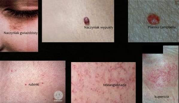 Kompozycja zdjęć przedstawiających różne rodzaje zmian naczyniowych skóry: naczyniak gwiaździsty pod okiem, naczyniak wypukły, plamka Campbella, rubinki, teleangiektazje oraz skóra z kuperozą.