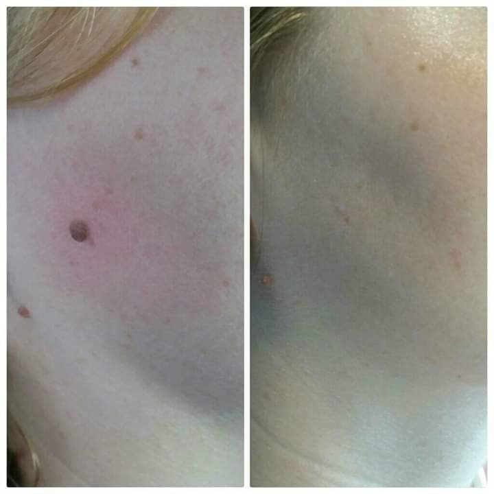 Porównanie skóry twarzy przed i po zabiegu usuwania znamion. Po lewej stronie widoczny zaczerwieniony obszar wokół usuniętego znamienia, po prawej stronie skóra po zabiegu, z widocznym niewielkim...