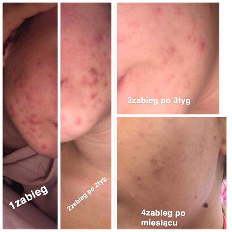 Ewolucja stanu skóry twarzy po serii zabiegów: widoczne zmiany po pierwszym, drugim, trzecim zabiegu (po 2 i 3 tygodniach) oraz po miesiącu.