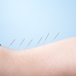 Centrum Fizjoterapii Funkcjonalnej Paweł Szuba - Ciało pacjenta z wbitymi cienkimi igłami do akupunktury w okolicy lędźwiowej, widoczne fragmenty czarnej odzieży i jasnoniebieskie tło.